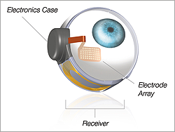 Diagram showing inner-eye with Argus II implanted